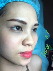 Kinh nghiệm cần biết trước và sau khi phẩu thuật nâng mũi