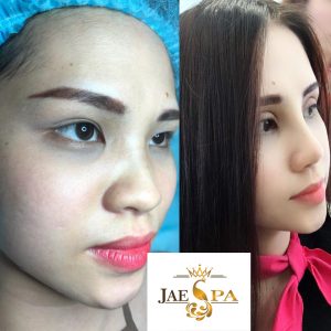 Nâng mũi đẹp nhất TDM