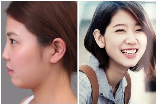 got-cam-v-line-gia-bao-nhieu