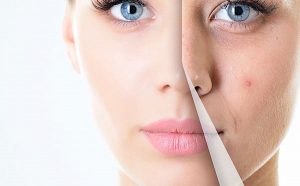 cach-tri-mun-hieu-qua