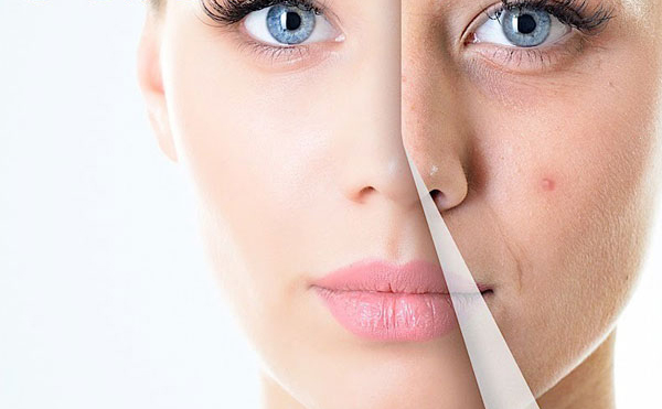 cach-tri-mun-hieu-qua