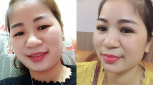 Cắt mí mắt đẹp tại Thủ Dầu Một