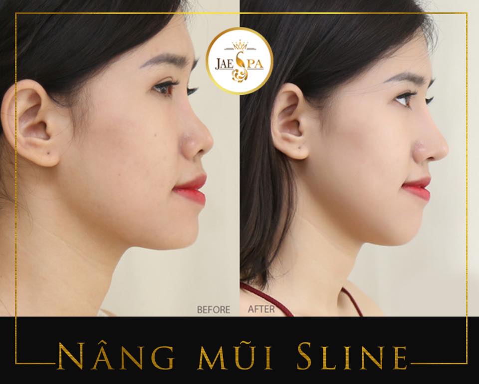Nâng mũi chuẩn Hàn đẹp nhất tại Bình Dương